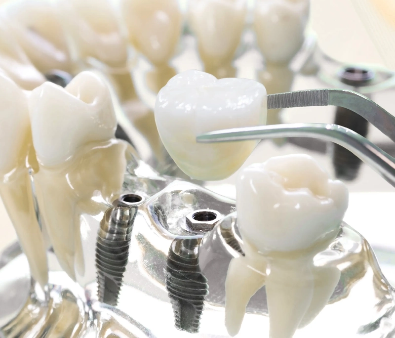 Răng Implant được làm từ chất liệu gì? Có an toàn không?